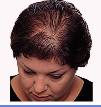home remedies for regrowing thinning hair